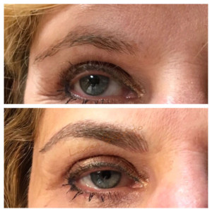 Eyebrow Correction - before and after
